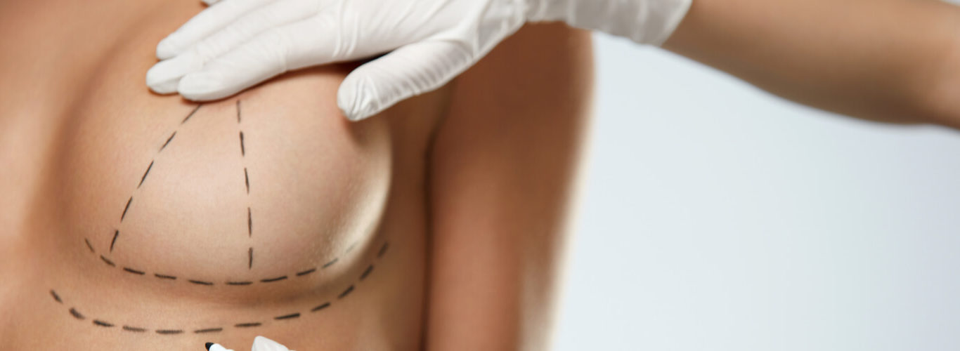 breastaug-gallery-1366×500