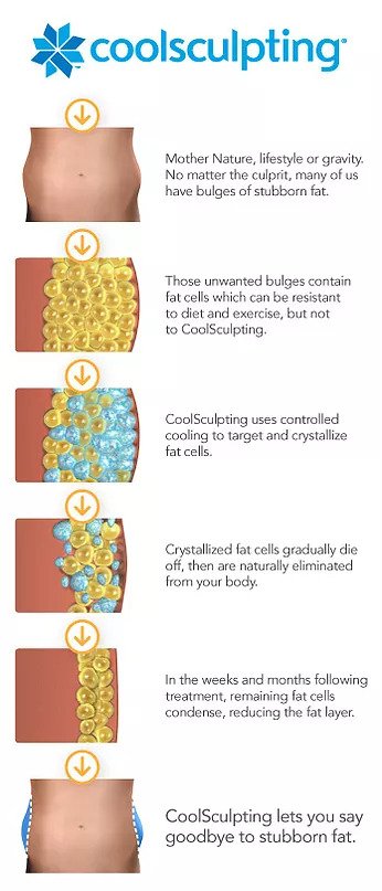 coolsculpting-1