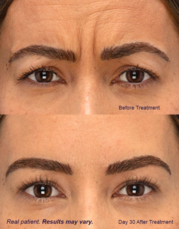 Botox Q12023 LP Lafayette, LA - Plastic Surgeon | Cosmetic Surgery | Dr ...