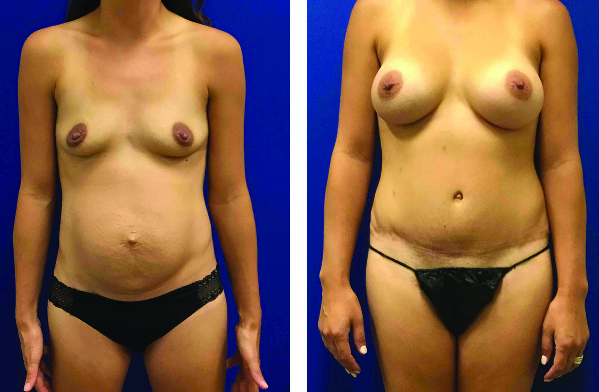 16058ba Front with Hernia Repair