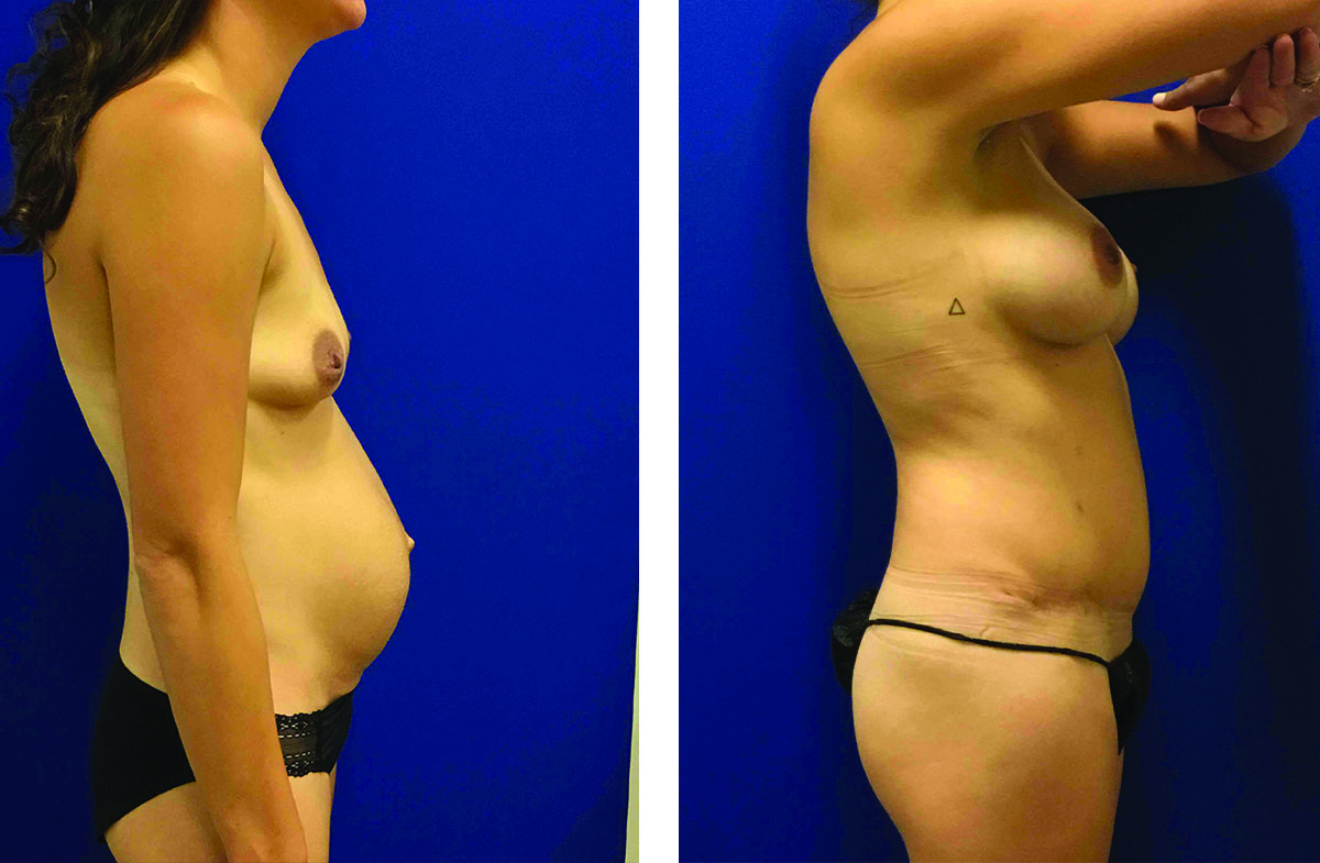 16058ba Right with Hernia repair