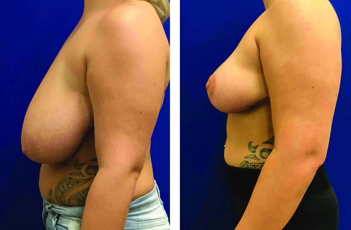 28268 ba BR Lipo Axillae Lt Side