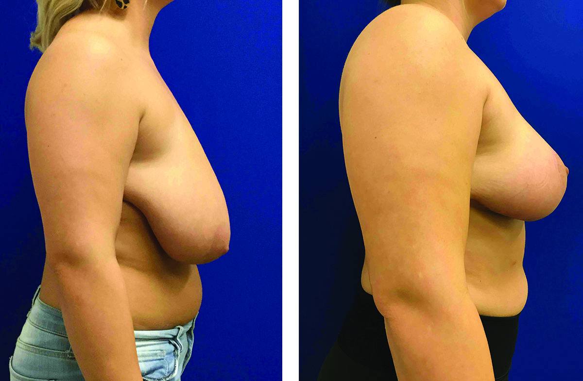 28268 ba BR Lipo Axillae Right