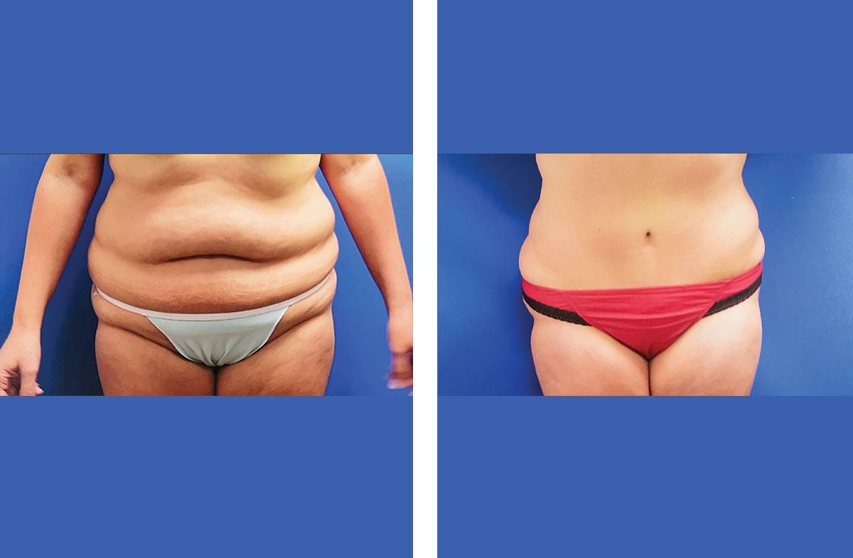 frontbeforeaftertt2