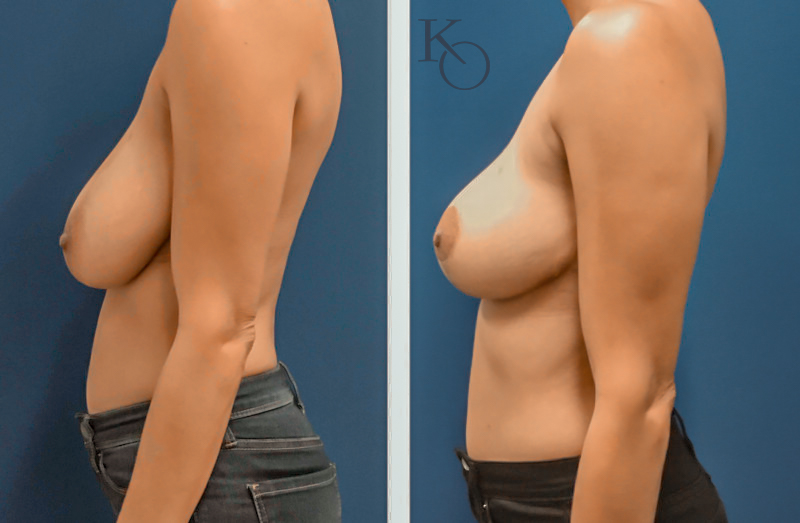 14445-ba-Left-View-800×523