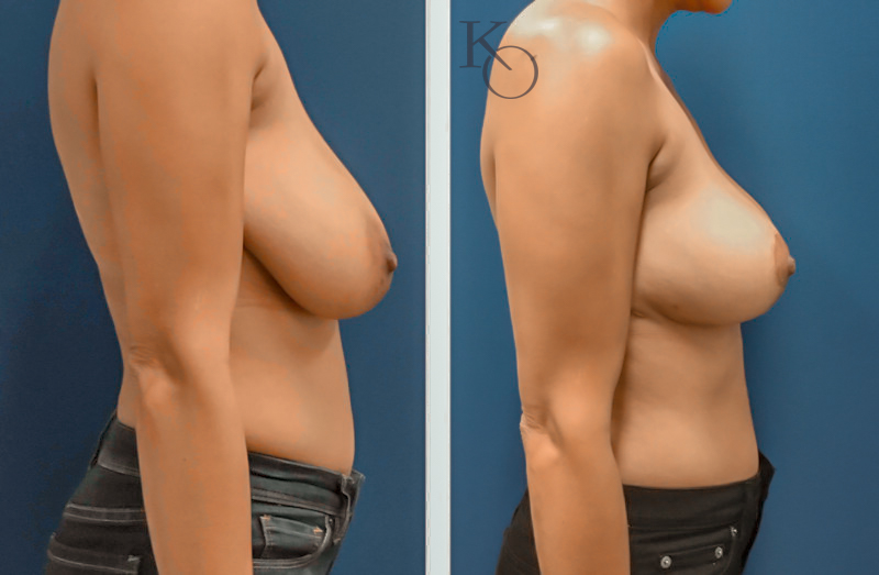 14445-ba-Right-View-800×523