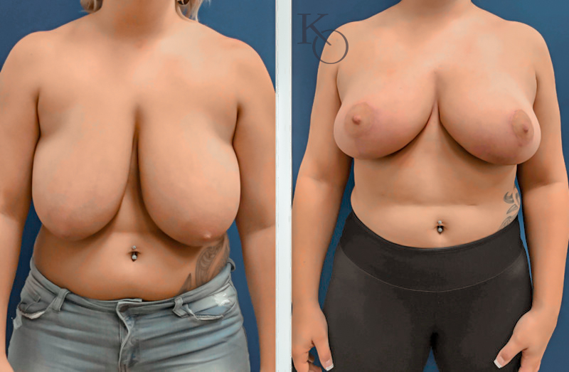 28268-ba-BR-Lipo-Axillae-Front-800×523