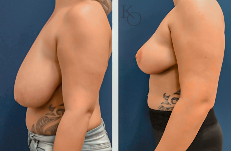 28268-ba-BR-Lipo-Axillae-Lt-Side-800×523