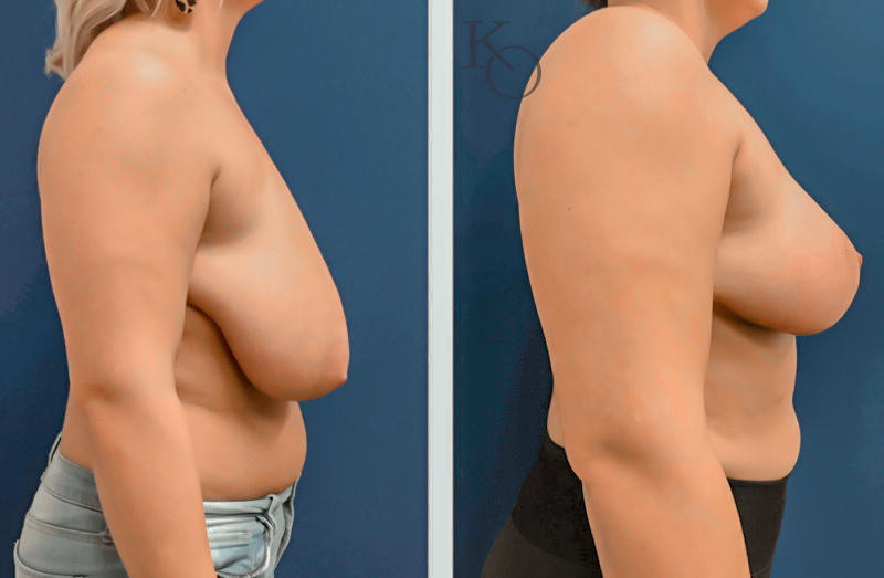 28268-ba-BR-Lipo-Axillae-Right-800×523