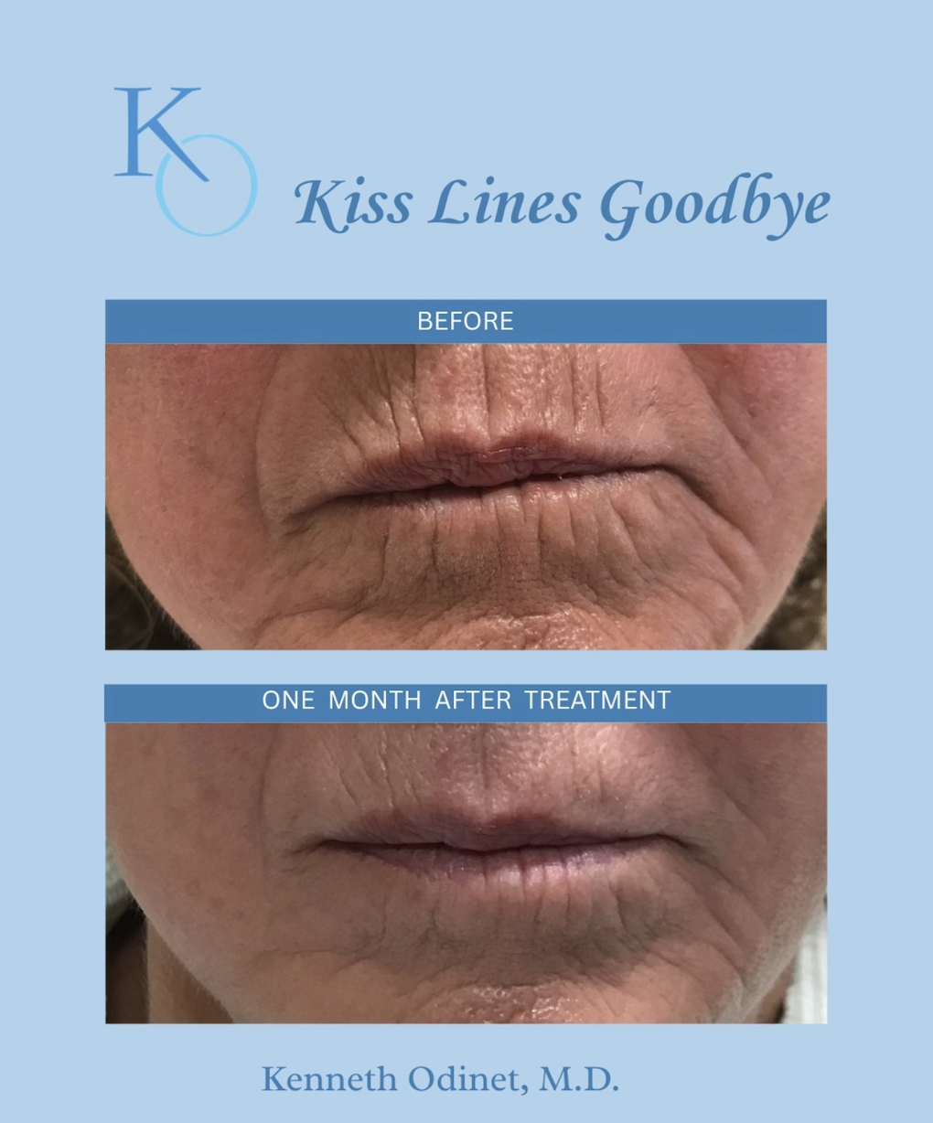 Before and After SKINVIVE treatment - Odinet Plastic Surgery and Skincare