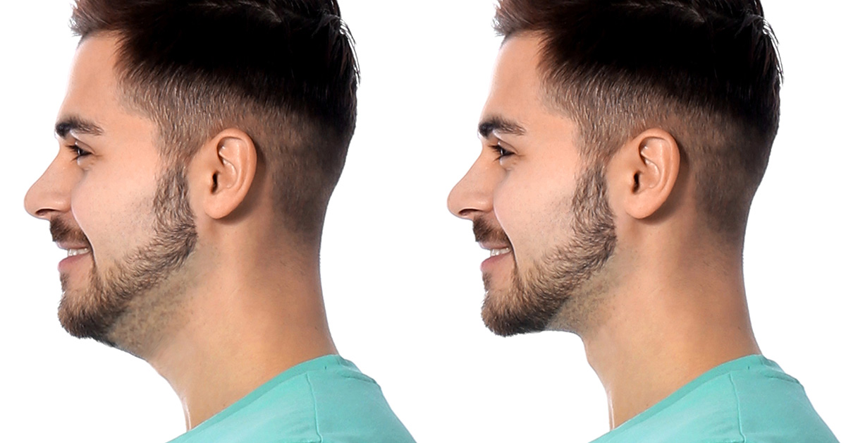Neck Lift