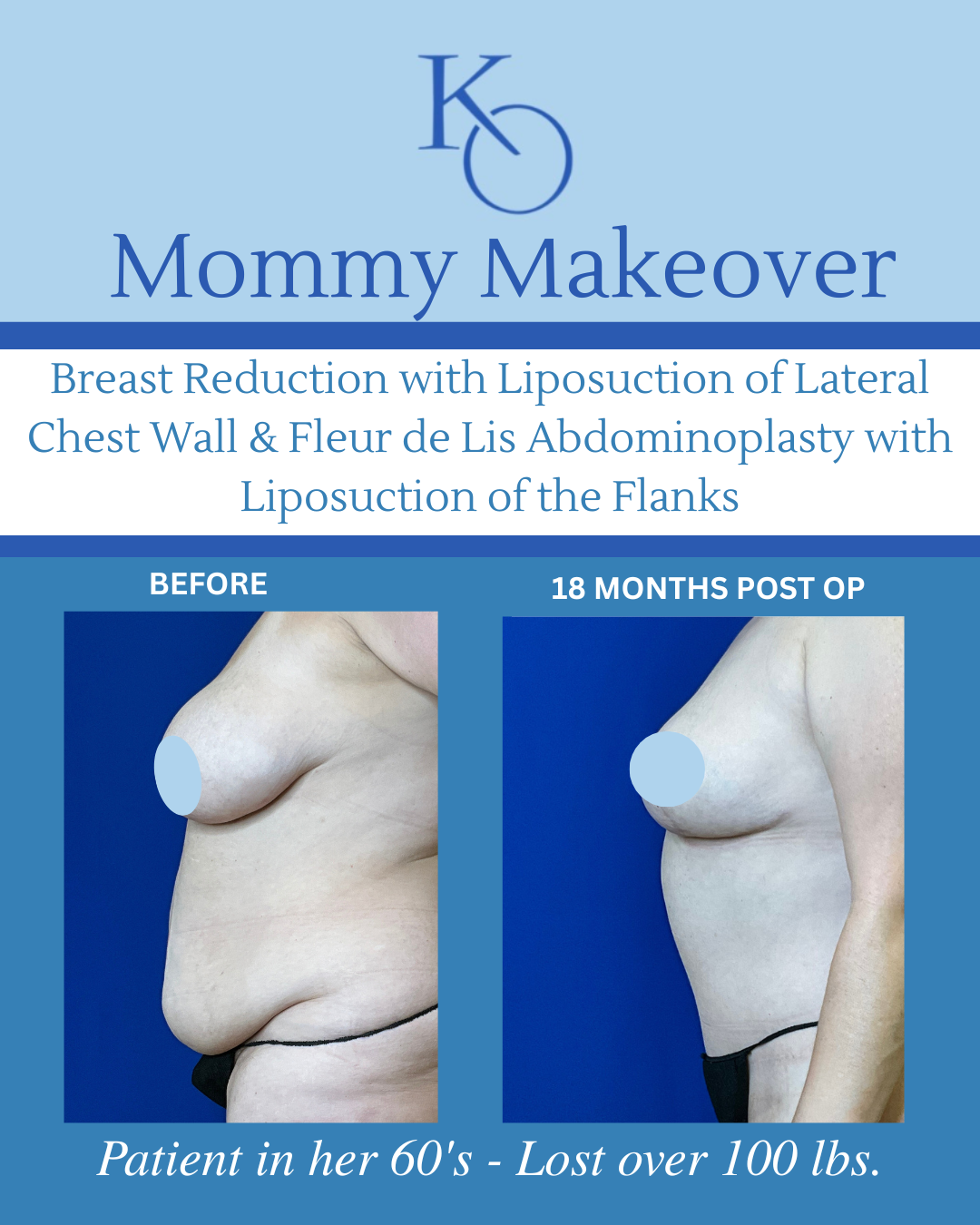 2 YRS POST OP copy 2