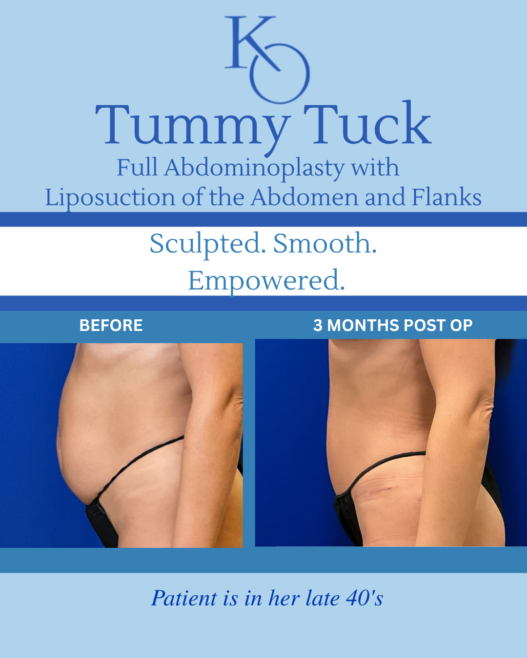 Abdominoplasty-3